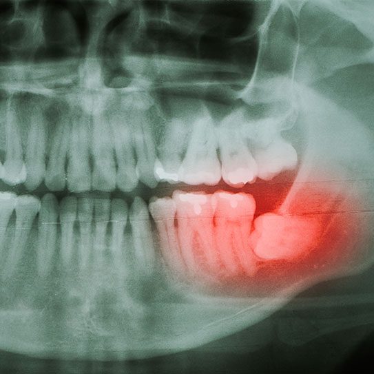 Fort Worth dentist wisdom tooth removal wisdom teeth