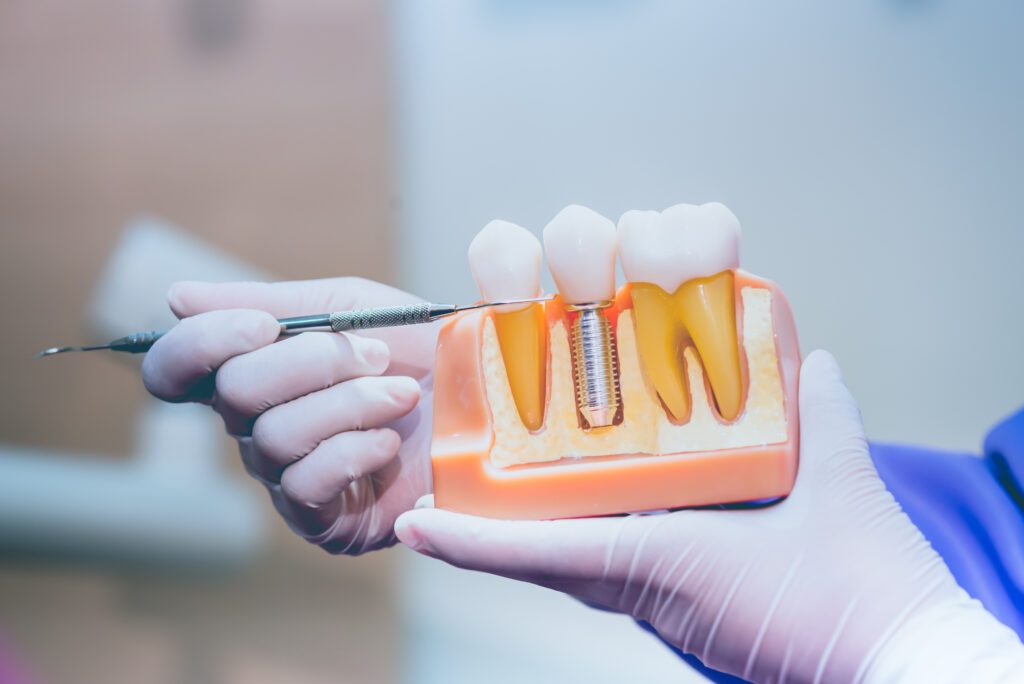 dental implants Fort Worth dentist near me