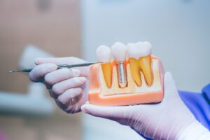 dental implants Fort Worth dentist near me